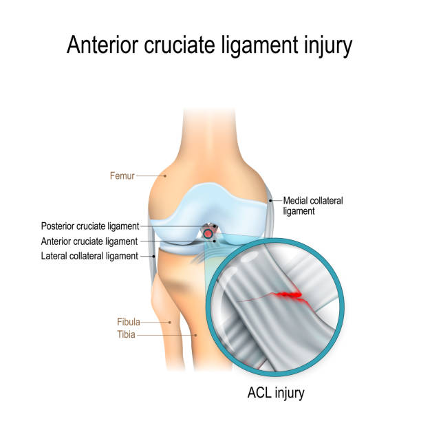 Diagram of the knee joint identifying an ACL injury location