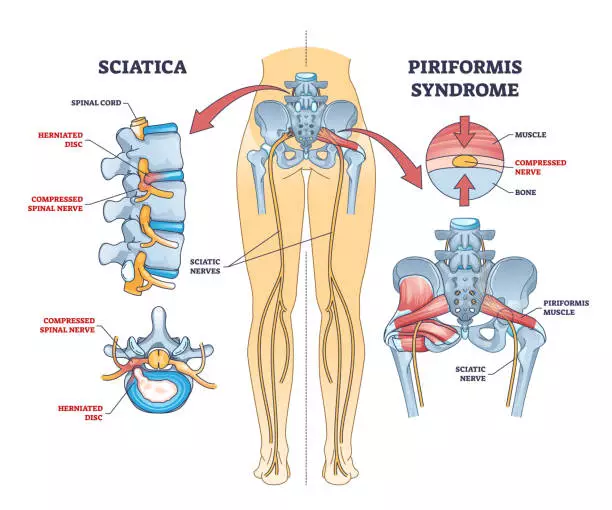 Diagram of how sciatica pain can develop in the spine from a compressed spinal nerve